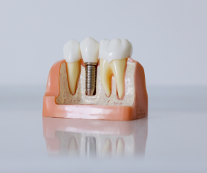Implant dentar